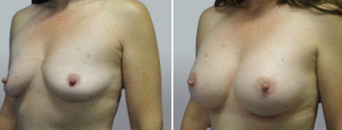 Breast Augmentation Mammoplasty (Implants) surgery images, patient 39, image 69, angle view