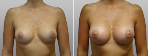 Breast Augmentation Mammoplasty (Implants) before & after images, front view