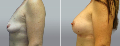 Breast Augmentation Mammoplasty (Implants) images, patient 39, image 70, side view