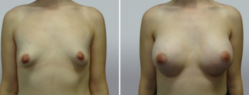 Breast Augmentation Mammoplasty (Implants)  before and after images, patient 40, image 71, front view