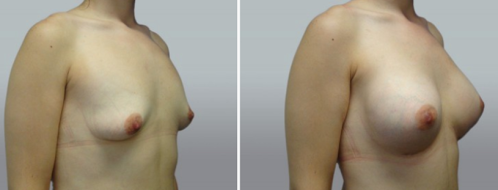 Breast Augmentation Mammoplasty (Implants)  surgery, patient 40, image 72, angle view