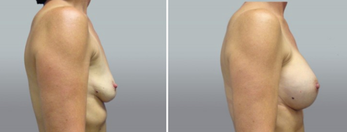 Image of patient 41 before and after breast augmentation, side view