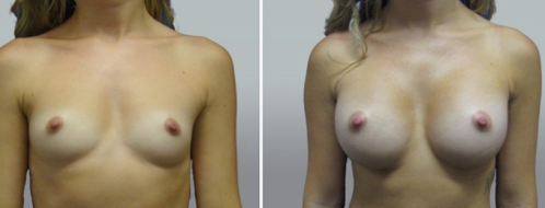 Breast Augmentation Mammoplasty (Implants) before & after surgery images, patient 42, image 77,  front view