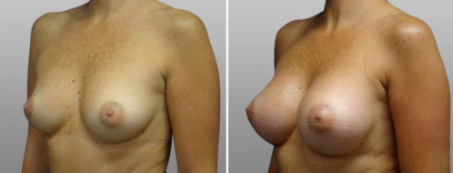 Breast enlargement before and after 08, angle view