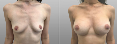 Breast Augmentation Mammoplasty (Implants)  surgery before and after images, patient 45, image 80, front view