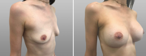 Breast augmentation before and after, patient 45, image 81, before & after