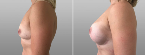 Breast augmentation surgery, before and after gallery, patient 46, image 84, side view