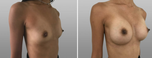 Boob job surgery, patient 48, image 87, angle view, before & after