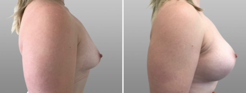 Patient 49 before and after breast augmentation, image 89, side view