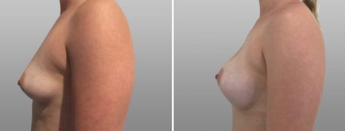 Breast Augmentation Mammoplasty (Implants) before & after images, patient 51, image 93, side view