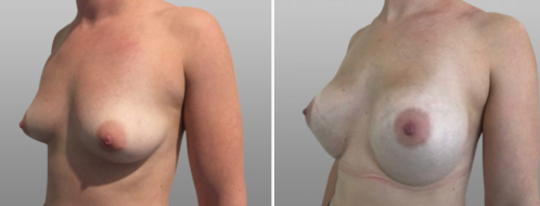 Breast Augmentation Mammoplasty (Implants) patient, image 94, before & after surgery images, angle view