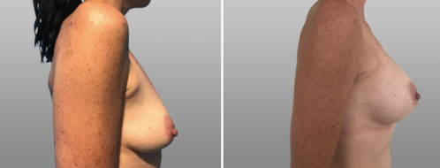 Patient 52 before & after breast augmentation, image 96, side view