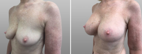Breast Augmentation Mammoplasty (Implants) photos, patient 53, before and after images,  image 97, angle view