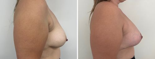 Breast Lift and Implants (Mastopexy with Augmentation Mammoplasty) before and after images, side view