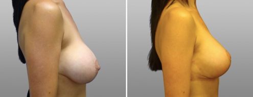 Breast lift and implants before and after, patient 01, image 01, side view