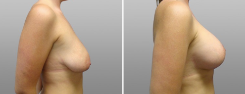 Patient before and after breast lift  with implants surgery, image 16, Dr Norris Sydney