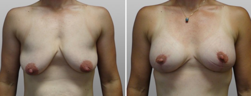 Breast Lift and Implants (Mastopexy with Augmentation Mammoplasty) before & after images, patient 08, front view
