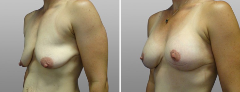 Mastopexy augmentation, patient 08, angle view, before and after photo