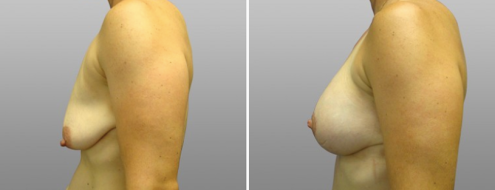 Breast lift and implants, image gallery, patient 08, side view