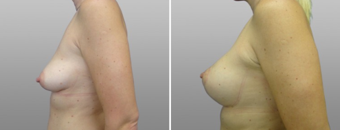 Breast Lift and Implants (Mastopexy with Augmentation Mammoplasty) photos, patient 09, image 21, side view