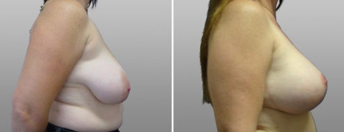 Breast lift and implants, patient 10, image 22