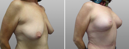 Breast lift with implants surgical procedure, patient 11, before and after image, angle view