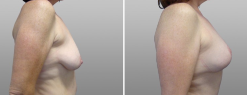 Breast lift & implants, image 24, side view, patient 11
