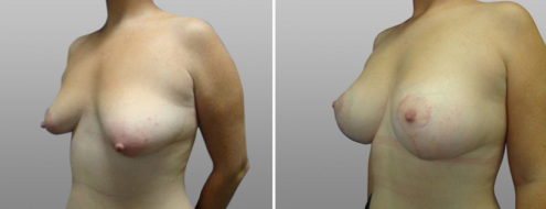 Breast Lift and Implants (Mastopexy with Augmentation Mammoplasty), before & after images, patient 12, angle view
