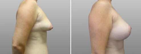 Breast lift & implants, patient 12, side view, before and after photo