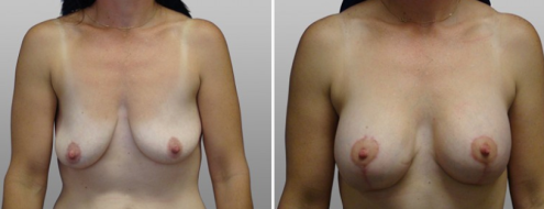 Breast lift with implants gallery, Dr Norris Sydney, front view, patient 14, image 28