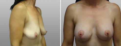 Breast Lift and Implants (Mastopexy with Augmentation Mammoplasty) before and after images, patient 14, image 29, front view