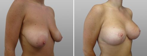 Breast lift with implants surgery, before & after gallery, patient 03, image 03, angle view