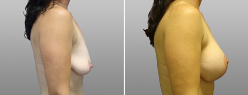 Patient before and after augmentation mastopexy, image 30, side view