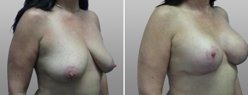 Breast Lift and Implants (Mastopexy with Augmentation Mammoplasty) patient 04, Dr Norris Sydney, image 06, angle view