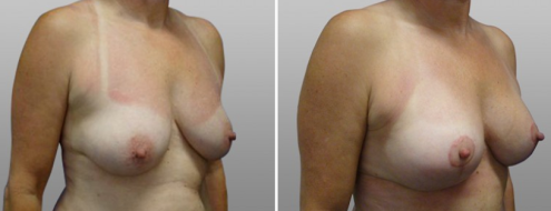 Breast lift & augmentation, before and after photos, patient 05, angle view