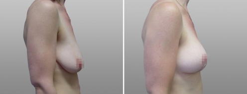 Before and after breast lift surgery, patient 03, image 01, side view
