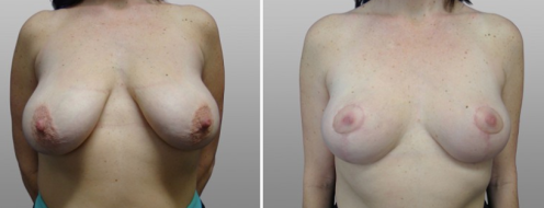 Breast Lift (Mastopexy) before & after images, patient 05, image 10, front view