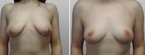 Breast Lift (Mastopexy) photos, before & after images, patient 06, image 13, front view