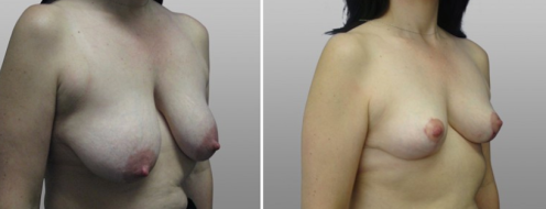 Breast lift before and after, image 15, patient 07, Dr Norris, Form & Face Sydney