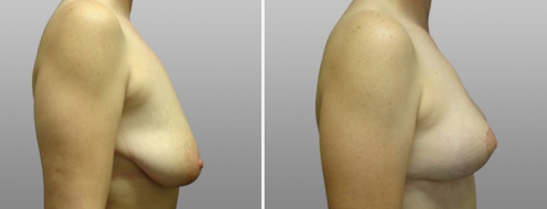Breast Lift (Mastopexy) before and after images, patient 02, side view