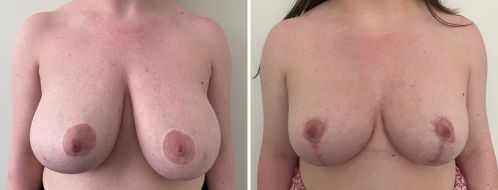 Breast Reduction Mammoplasty before and after images, front view