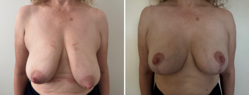 Breast Reduction Photos 1 Breast Reduction Mammoplasty before and after photos post-op 4 months, client 28, Front view