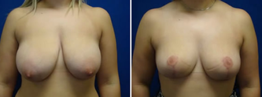 Breast Reduction Mammoplasty before and after images, patient 32, image 01, front view