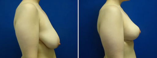 Breast Reduction Mammoplasty, before & after gallery images, patient 04, image 12, side view