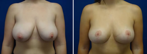Patient 05, Breast Reduction Mammoplasty at Form & Face clinic Sydney, before & after images, front view
