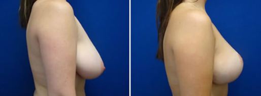 Breast Reduction Mammoplasty, Form & Face patient 05, image 15, side view