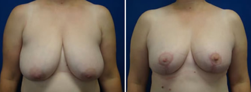 Breast Reduction Mammoplasty, before and after images, patient 06, image 16, front view