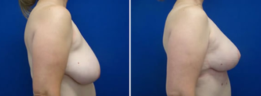Breast Reduction Mammoplasty images patient 06 before and after the surgery, image 18, side view