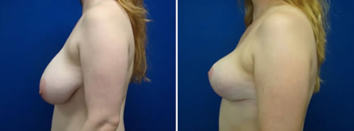 Breast Reduction Mammoplasty images, image 21, patient 07, side view