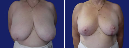 Form & Face Breast Reduction Mammoplasty images, patient 09, image 25, front view